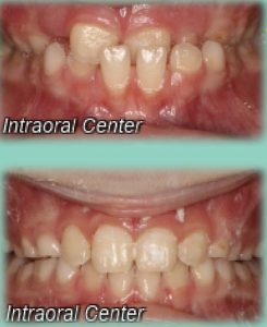 braces cost in Truro NS before and after